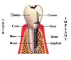 implantate2