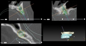 implantate23